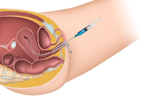 如何通过宫腔内人工授精 (IUI) 增加怀孕机会 - 辅助生殖论坛-辅助生殖论坛